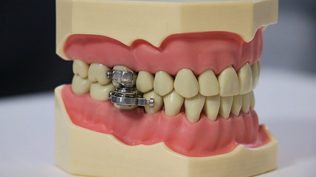 Scientists and medical professionals have created a weight loss device that locks a person's jaw shut.